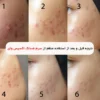مراحل کرم کپسولی کنترل منافذ اکسیس وای Axis-Y مدل calamine